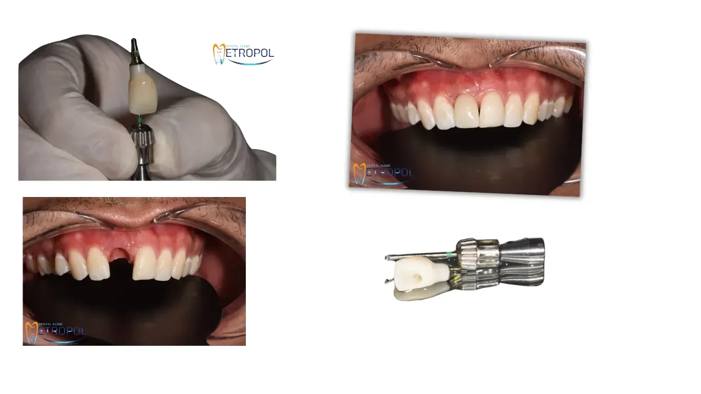 Oral İmplantoloji